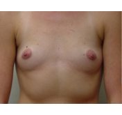 Before Breast Augmentation